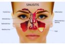 Viêm xoang: Nguyên nhân, chẩn đoán và cách điều trị hiệu quả