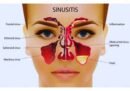 Viêm xoang: Nguyên nhân, chẩn đoán và cách điều trị hiệu quả