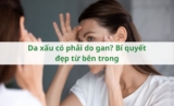 Da xấu có phải do gan? Bí quyết đẹp từ bên trong