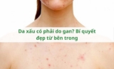 Da xấu có phải do gan? Bí quyết đẹp từ bên trong