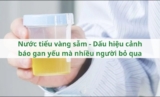 Nước tiểu vàng sẫm – Dấu hiệu cảnh báo gan yếu mà nhiều người bỏ qua