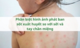 Phân biệt hình ảnh phát ban sốt xuất huyết so với sởi và tay chân miệng