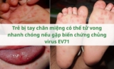 Trẻ bị tay chân miệng có thể tử vong nhanh chóng nếu gặp biến chứng chủng virus EV71