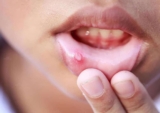 Tìm hiểu về nhiệt miệng: nguyên nhân và cách thức điều trị
