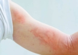 Nổi mề đay là gì? Nguyên nhân, cách phòng chống và điều trị nổi mề đay