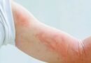 Nổi mề đay là gì? Nguyên nhân, cách phòng chống và điều trị nổi mề đay