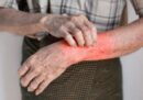 Mề đay ngứa về đêm: Nguyên nhân, Cách chẩn đoán, Phương pháp điều trị