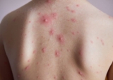 Mẩn ngứa do gan biểu hiện thế nào? Nguyên nhân, Cách chẩn đoán, Điều trị