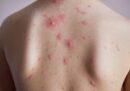 Mẩn ngứa do gan biểu hiện thế nào? Nguyên nhân, Cách chẩn đoán, Điều trị