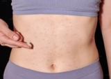 Mẩn ngứa ở bụng là dấu hiệu của bệnh gì? Cách điều trị và Phòng tránh