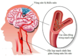 Cách xử lý khi bị thiếu máu não hiệu quả tại nhà