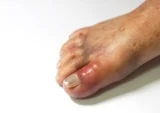Sưng khớp là gì? Nguyên nhân, triệu chứng & Cách chữa khớp sưng tấy