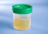 Nước tiểu có bọt có nguy hiểm không? Nguyên nhân, Chẩn đoán, Phòng tránh
