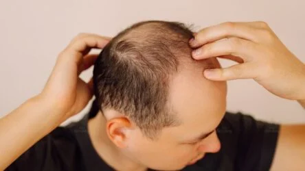 Rụng tóc nhiều ở nam: Nguyên nhân, Cách cải thiện tại nhà