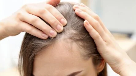 Rụng tóc nhiều ở nữ giới: Nguyên nhân, triệu chứng và giải pháp khắc phục