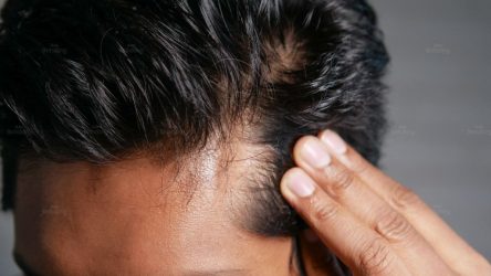 Thiếu máu có gây rụng tóc không? Nguyên nhân, dấu hiệu và cách cải thiện