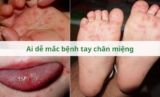 ​Ai dễ mắc bệnh tay chân miệng