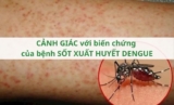 ​Cảnh giác với biến chứng của bệnh sốt xuất huyết Dengue